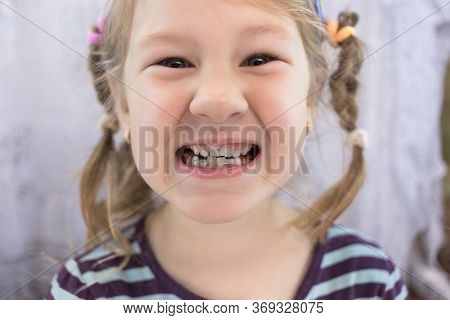 Adult Permanent Teeth Coming In Front Of The Child's Baby Teeth: Shark Teeth. Little Girl's Open Mou