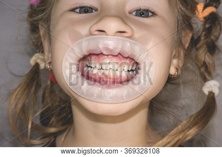 Adult Permanent Teeth Coming In Front Of The Child's Baby Teeth: Shark Teeth. Little Girl's Open Mou