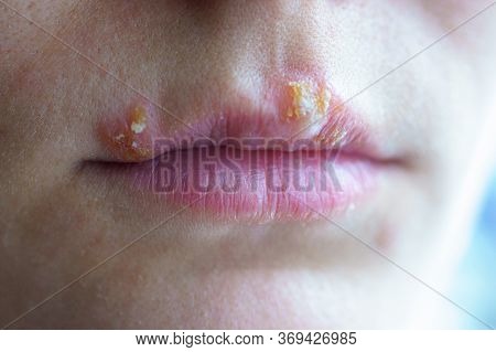 Herpes Disease On The Lips Of A Young Girl. Wounds From Herpes On The Lips Of A Person. Herpes Foci.