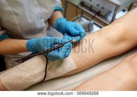 Close Up View Of Electroepilation, Hair Removal Process Using Needle And Tweezers