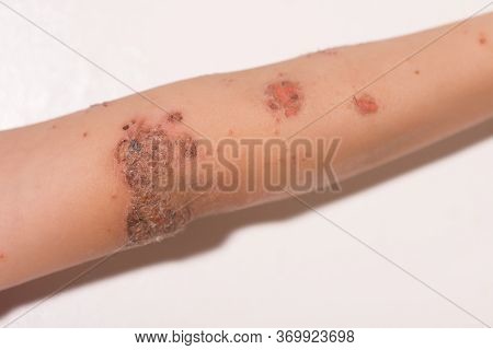 Impetigo (skin Infection) On A Child's Arm