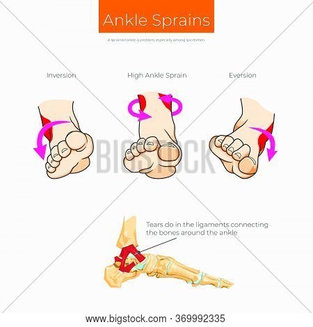 Types Of Ankle Sprain Scheme. Injuries And Pain In The Leg