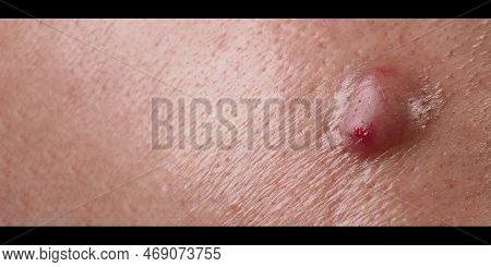 Big Acne Cyst Abscess Or Ulcer Swollen Area Within Face Skin Tissue.