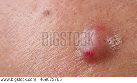 Big Acne Cyst Abscess Or Ulcer Swollen Area Within Face Skin Tissue.