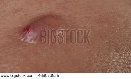Big Acne Cyst Abscess Or Ulcer Swollen Area Within Face Skin Tissue.