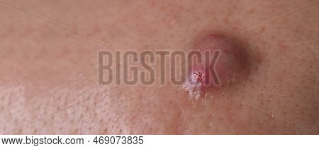 Big Acne Cyst Abscess Or Ulcer Swollen Area Within Face Skin Tissue.