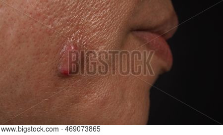 Big Acne Cyst Abscess Or Ulcer Swollen Area Within Face Skin Tissue.