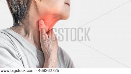 Redness At The Neck Of Asian, Myanmar Woman. Concept Of Sore Throat, Pharyngitis, Laryngitis, Esopha