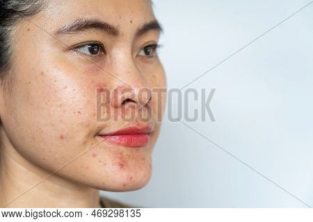Close Up Of Asian Woman Having Acne Inflamed On Her Face With White Copy Space. Inflamed Acne Consis