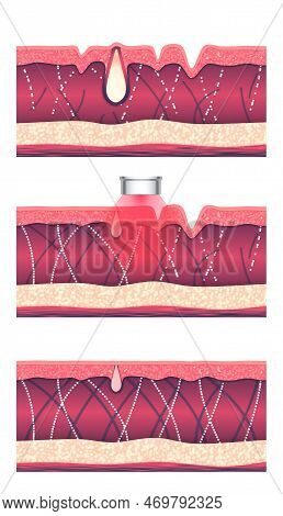 Laser Skin Resurfacing Therapy. Wrinkle Reduction And Acne Treatment Process. Step By Step Illustrat