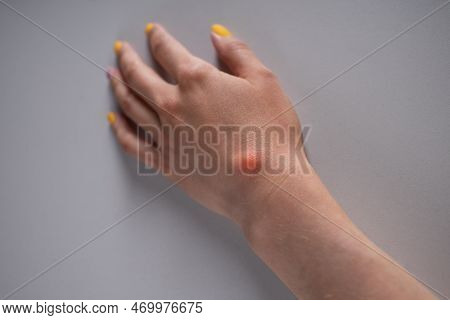 Ganglion Cyst On Woman Hand On White Background