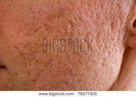 Acne Scars On Cheek