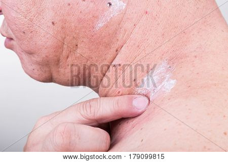 Man Applying Antibiotic Cream Onto Wound From Removed Mole