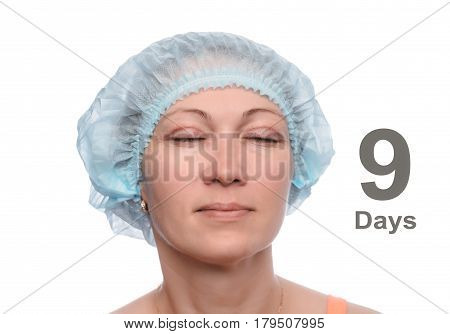 Blepharoplasty of the upper eyelid. An operation that removes the excess ugly skin of the eyelids above the eyes. The eyes are closed. Photos are taken at different times to track the healing process of the skin. Nine days after the operation.