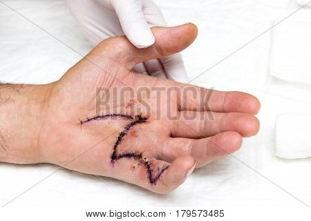 Image of a hand with big suture after surgery