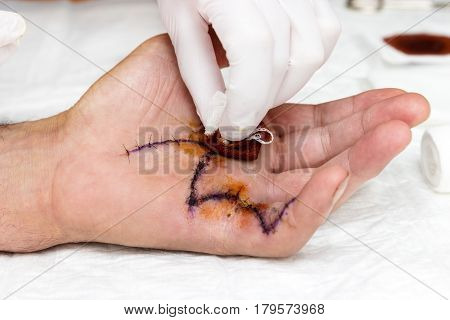 A fresh surgical scar on the palm is beeing disinfected with iodine