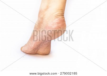 Close Up Of Single Female Leg Or Heel Showing Dried  Cracked Heel With Dried Skin Isolated On White