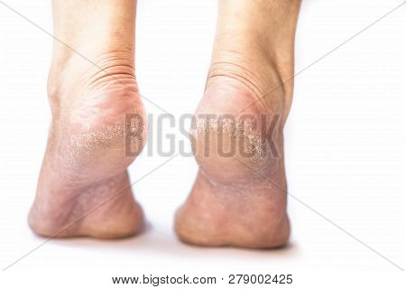Close Up Of  Female Leg Or Heel Showing Dried  Cracked Heel With Dried Skin Isolated On White Concep