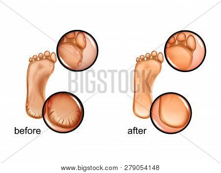 Vector Illustration Of A Calluses And Cracked Heels