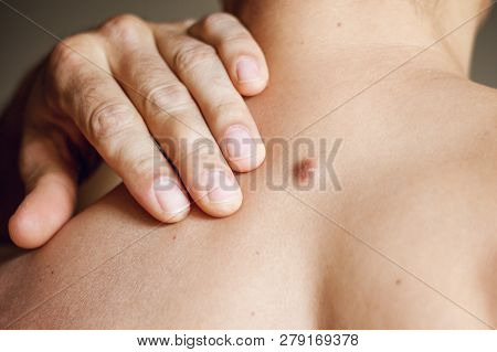 Fibroma On The Male Back, Details, Close-up
