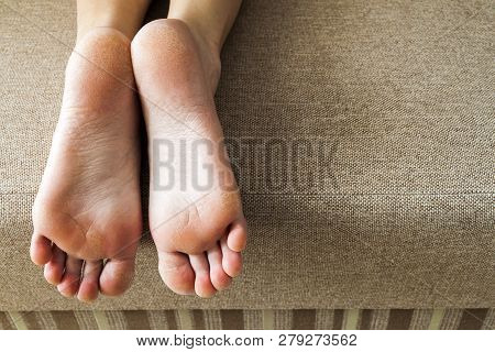 Dry Cracked Skin Of Woman Feet In Bed. Foot Treatment.