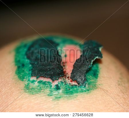 Healing Wound On The Knee. The Wound Treated With Brilliant Green. The Scab Will Climb