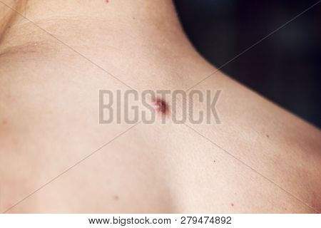 Fibroma On The Male Back, Details, Close-up