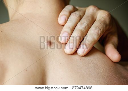 Fibroma On The Male Back, Details, Close-up