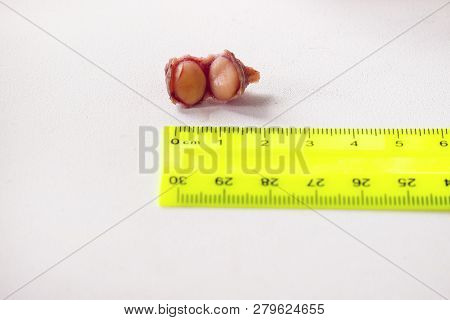 Fibroma, Mole Close-up In A Cut On A White Background
