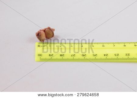 Cut Out Fibroma, Mole For Microscopic Examination, White Background, Close-up, Biopsy