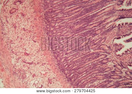 Microscope Photo Of A Large Intestine Section With Inflammation (colitis).