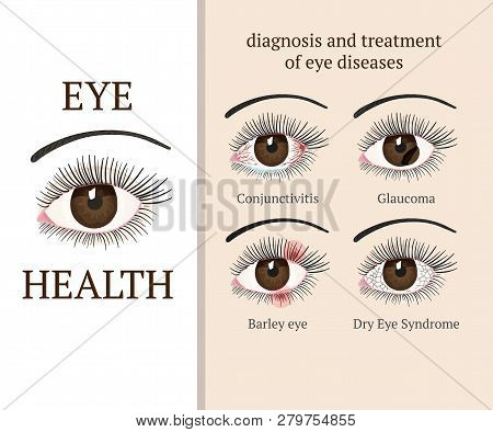 Eye Disease. Most Common Eye Problemc - Conjunctivitis, Glaucoma, Dry Eye Syndrome, Barley Eyes. Oph