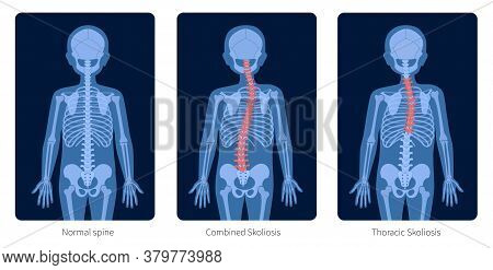 Normal Spine And Types Of Spine Defects. Scoliosis In Child Body. Xray Flat Vector Illustration. Bac