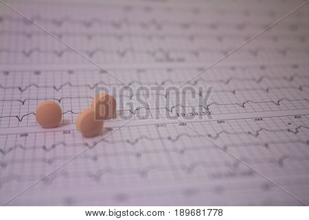 Background of a three-channel holter electrocardiogram of a patient with cardiac pacemaker and three pills