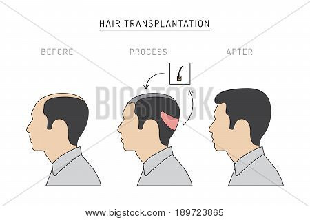 Infographics on the subject of hair transplantation on the example of a man with a picture of the result of transplantation before and after. Vector image of a patient isolated on white background