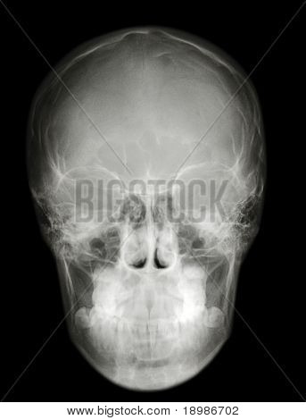 รูปภาพถ่ายภาพเอ็กซ์เรย์ roentgenogram โพรไฟล์ cranium แจว