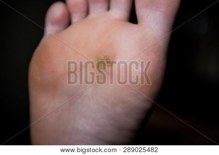 Corn On Man Foot Close Up On