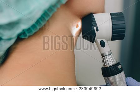 Skin Moles Treatment. Laser Mole Removal At Clinic
