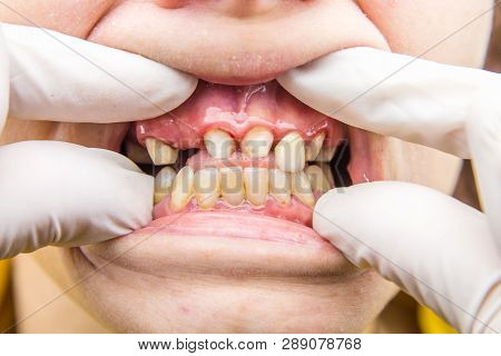 Close Up Of Destructed Teeth, Broken Tooth Closeup. Girl At The Dental Reception.