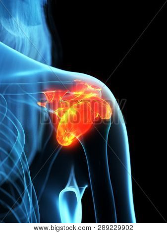 3d rendered medically accurate illustration of inflamed ligaments