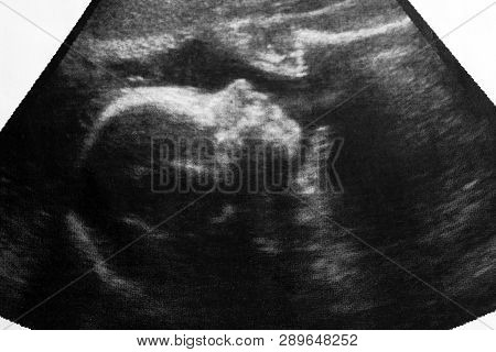 Ultrasound Photo Of Unborn Baby In Mother's Womb, Closeup View