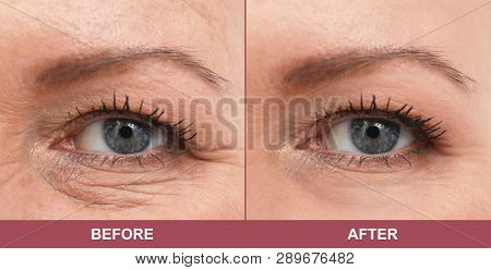 Mature Woman Before And After Biorevitalization Procedure, Closeup. Cosmetic Surgery
