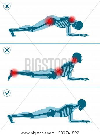 Wrong And Correct Plank Position. Right And Wrong Execution Technique Of Sport Exercise. Common Mist