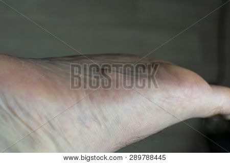 Plantar Fibromatosis Fascialis Also Known As Ledderhose's Disease On The Bottom Of A Foot
