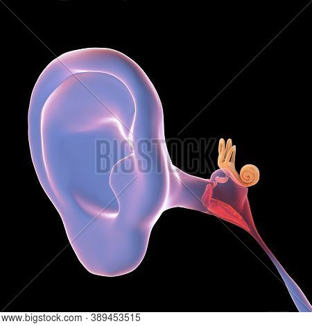 Otitis Media, A Group Of Inflammatory Diseases Of The Middle Ear, 3d Illustration