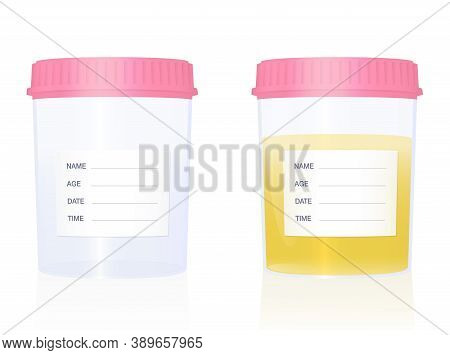 Urine Sample - Specimen Cups For Gynecological Analysis - With Blank Labels And Pink Screw Caps - Em