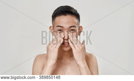 Portrait Of Young Asian Man With Problematic Skin And Hyperpigmentation Looking At Camera, Applying 