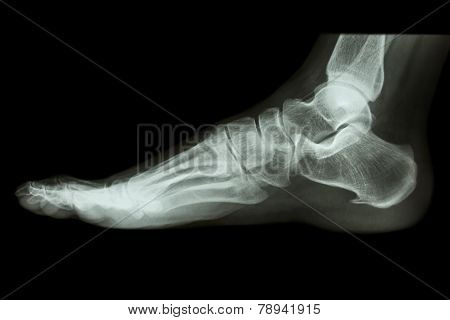 X-ray Normal Human's Foot Lateral