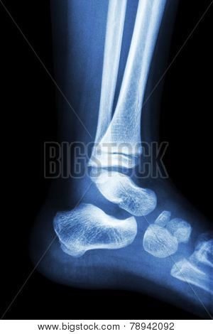 Film X-ray Normal Child's Ankle