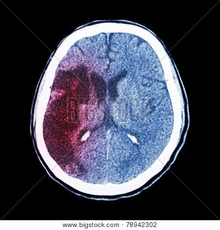 Ct Brain : Show Ischemic Stroke